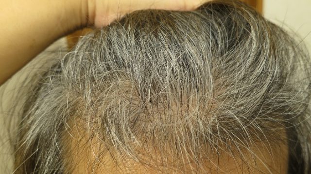 フィナロイド＆ミノキシジルを服用して２か月後の髪の毛を撮影した写真